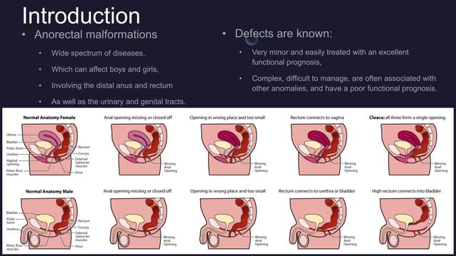 case study on anorectal malformation slideshare