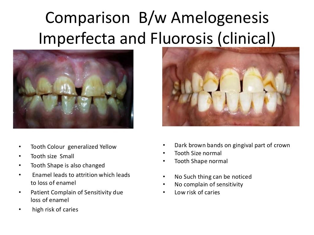 Case presentation Fluorosis