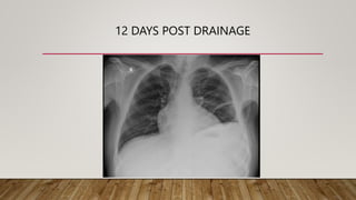 12 DAYS POST DRAINAGE
 