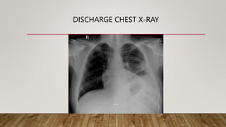 DISCHARGE CHEST X-RAY
 