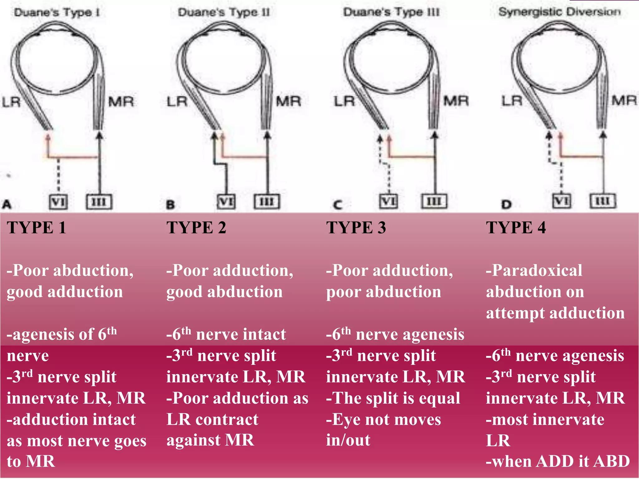 TYPE 1

TYPE 2

TYPE 3

TYPE 4

-Poor abduction,
good adduction

-Poor adduction,
good abduction

-Poor adduction,
poor abduction

-Paradoxical
abduction on
attempt adduction

-agenesis of 6th
nerve
-3rd nerve split
innervate LR, MR
-adduction intact
as most nerve goes
to MR

-6th nerve intact
-3rd nerve split
innervate LR, MR
-Poor adduction as
LR contract
against MR

-6th nerve agenesis
-3rd nerve split
innervate LR, MR
-The split is equal
-Eye not moves
in/out

-6th nerve agenesis
-3rd nerve split
innervate LR, MR
-most innervate
LR
-when ADD it ABD

 