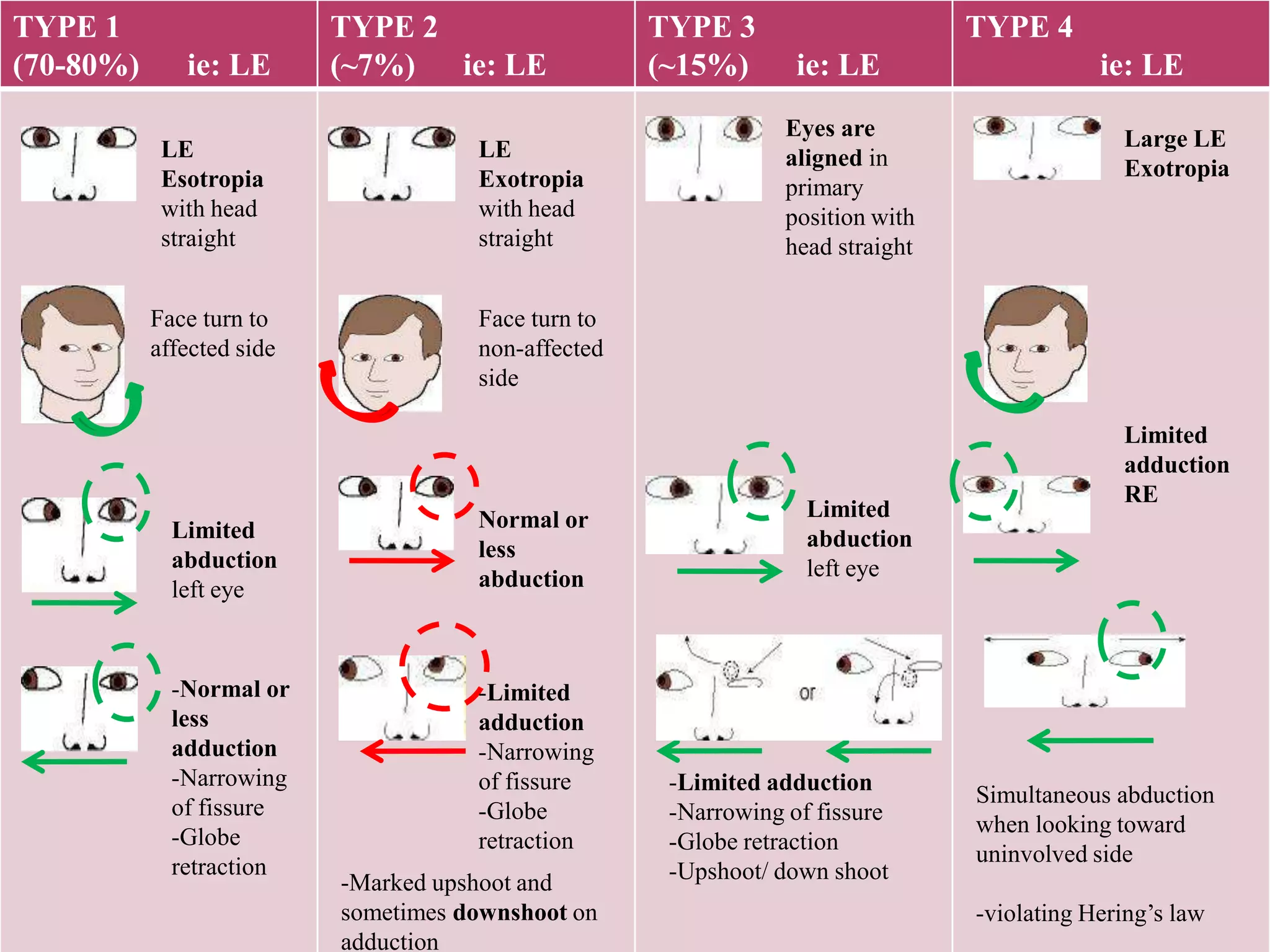 TYPE 1
(70-80%)

ie: LE
LE
Esotropia
with head
straight
Face turn to
affected side

TYPE 2
(~7%)
ie: LE
LE
Exotropia
with head
straight

TYPE 3
(~15%)

TYPE 4
ie: LE
Eyes are
aligned in
primary
position with
head straight

ie: LE
Large LE
Exotropia

Face turn to
non-affected
side

Limited
abduction
left eye

Normal or
less
abduction

-Normal or
less
adduction
-Narrowing
of fissure
-Globe
retraction

-Limited
adduction
-Narrowing
of fissure
-Globe
retraction
-Marked upshoot and
sometimes downshoot on
adduction

Limited
abduction
left eye

-Limited adduction
-Narrowing of fissure
-Globe retraction
-Upshoot/ down shoot

Limited
adduction
RE

Simultaneous abduction
when looking toward
uninvolved side
-violating Hering’s law

 