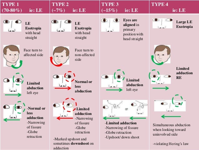 case presentation 2 duane s syndrome