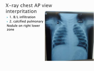  1. B/L infiltration
 2. calcified pulmonary
Nodule on right lower
zone
 