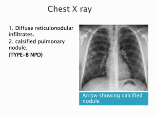 Arrow showing calcified
nodule
1. Diffuse reticulonodular
infiltrates.
2. calsified pulmonary
nodule.
(TYPE-B NPD)
 