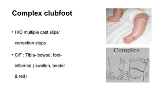 CASE PRESENTATION CLUB FOOT management.pptx
