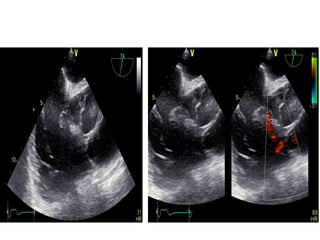 Case presentation ,double chambered right ventricle | PPTX