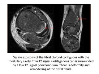 Remodelling Tibia CASE PRESENTATION DR MOVIL radiology .pptx