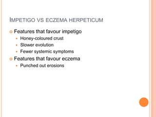 IMPETIGO VS ECZEMA HERPETICUM
   Features that favour impetigo
     Honey-coloured crust
     Slower evolution
     Fewer systemic symptoms

   Features that favour eczema
       Punched out erosions
 