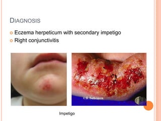 DIAGNOSIS
 Eczema herpeticum with secondary impetigo
 Right conjunctivitis




                   Impetigo
 