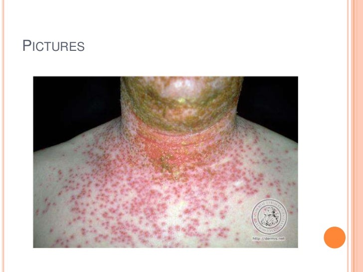 Case presentation eczema herpeticum