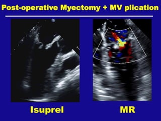 Post-operative Myectomy + MV plication
Isuprel MR
 