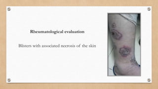 Rheumatological evaluation
Blisters with associated necrosis of the skin
 