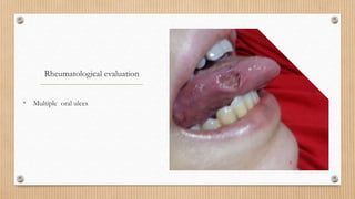Rheumatological evaluation
• Multiple oral ulces
 