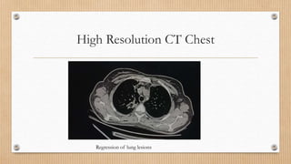 High Resolution CT Chest
Regression of lung lesions
 