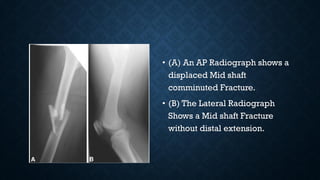 • (A) An AP Radiograph shows a
displaced Mid shaft
comminuted Fracture.
• (B) The Lateral Radiograph
Shows a Mid shaft Fracture
without distal extension.
 
