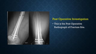 Post Operative Investigation
• This is the Post Operative
Radiograph of Fracture Site.
 
