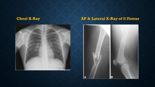 Chest X-Ray AP & Lateral X-Ray of ® Femur
 