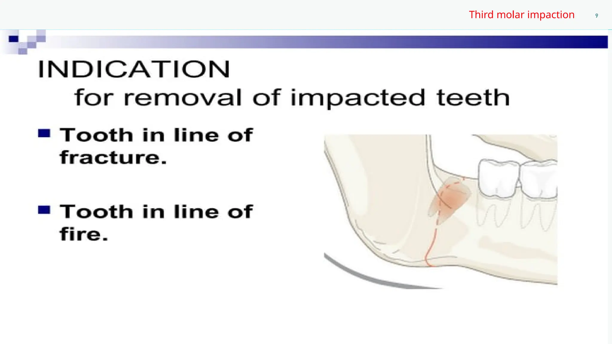 Case presentation about impacted third molar.pptx
