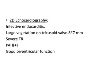 • 2D Echocardiography:
Infective endocarditis.
Large vegetation on tricuspid valve.8*7 mm
Severe TR
PAH(+)
Good biventricular function
 