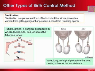 Sterilization
Sterilization is a permanent form of birth control that either prevents a
woman from getting pregnant or prevents a man from releasing sperm.
Tubal Ligation, a surgical procedure in
which doctor cuts, ties, or seals the
fallopian tubes.
Vasectomy, a surgical procedure that cuts,
closes, or blocks the vas deferens
 