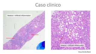 Caso clinico
Steatosi + Infiltrati infiammatori
Steatosi + Infiltrati infiammatori
Drssa Annika Blank
 