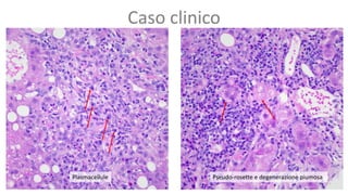 Caso clinico
Plasmacellule Pseudo-rosette e degenerazione piumosa
 