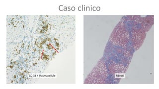 Caso clinico
CD 38 = Plasmacellule Fibrosi
 
