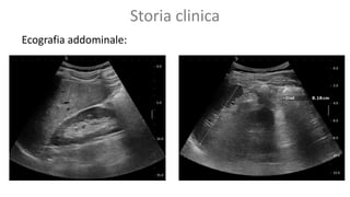 Storia clinica
Ecografia addominale:
 