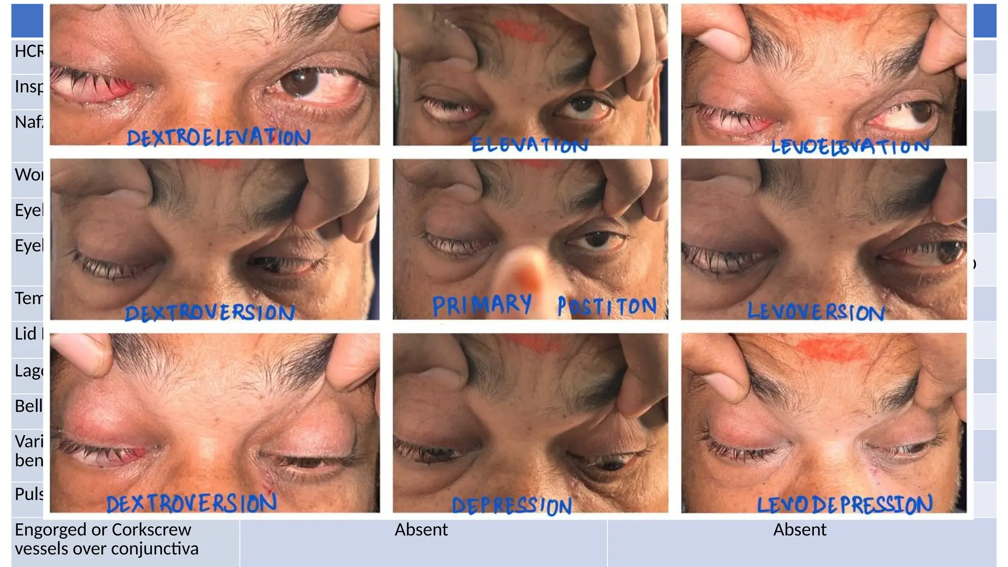 RE LE
HCRT 15 degrees esotropia Central
Inspection Axial proptosis Axial proptosis
Nafziger’s Sign Negative (swollen eyelid visible beyond orbital
rim)
Negative
Worm’s Eye View Anteroposterior displacement of eyeball Anteroposterior displacement of eyeball
Eyebrows Normal Normal
Eyelids BE RETRACTED
BE UPPER AND LOWER LIDS FULLNESS NOTED
BE RETRACTED
BE UPPER AND LOWER LIDS FULLNESS NOTED
Temporal Flare Present Present
Lid Lag on Down Gaze Present Present
Lagophthalmos Present Present
Bell’s Phenomenon Good Good
Variation with valsalva or
bending forwards
Absent Absent
Pulsatile Proptosis No No
Engorged or Corkscrew
vessels over conjunctiva
Absent Absent
 