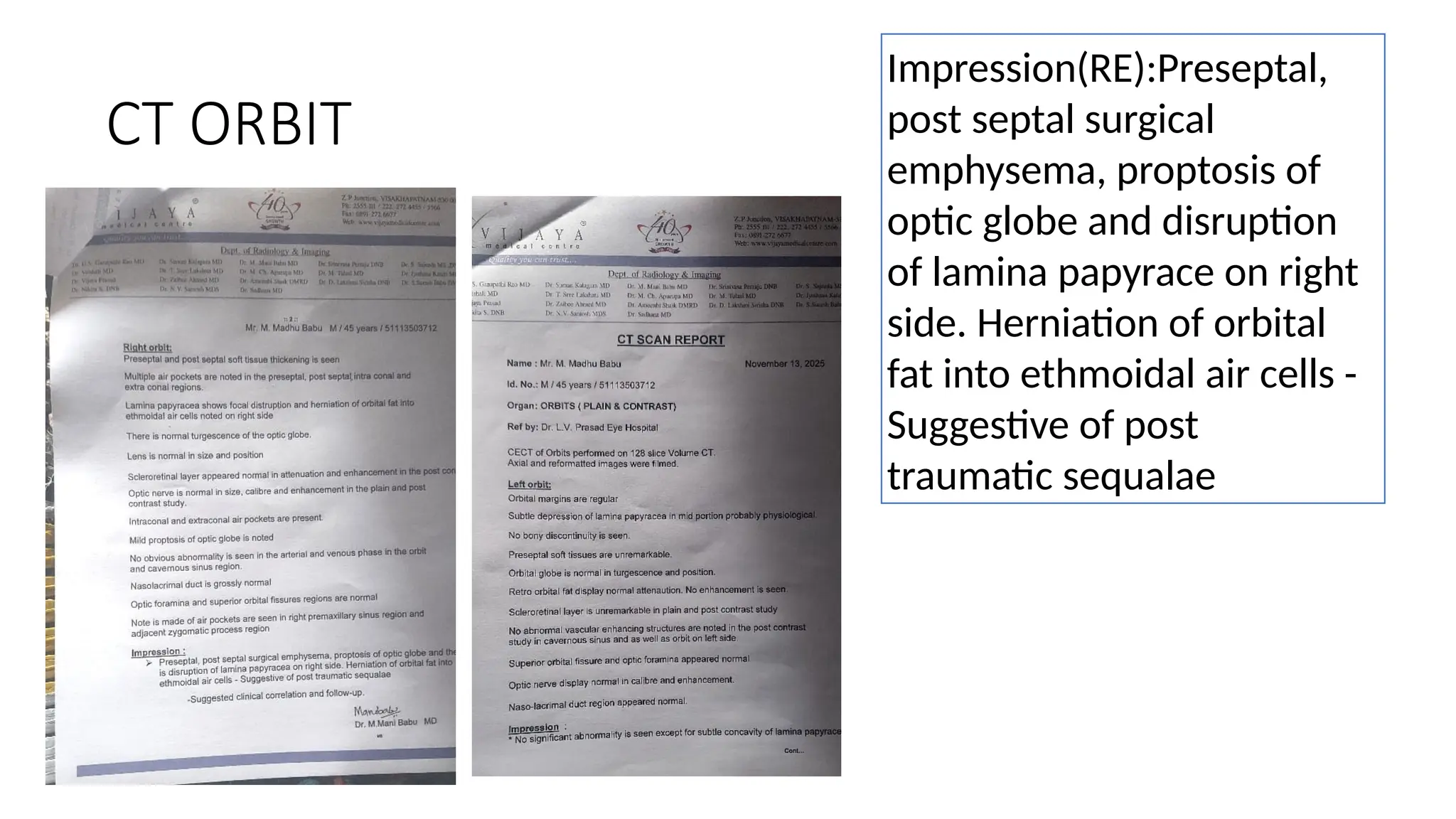 CT ORBIT
Impression(RE):Preseptal,
post septal surgical
emphysema, proptosis of
optic globe and disruption
of lamina papyrace on right
side. Herniation of orbital
fat into ethmoidal air cells -
Suggestive of post
traumatic sequalae
 