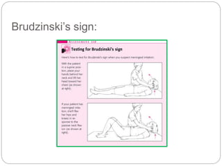 Brudzinski’s sign:
 