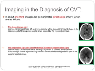 Imaging in the Diagnosis of CVT:
 In about one-third of cases,CT demonstrates direct signs of CVT, which
are as follows:
I. The dense triangle sign:
seen on noncontrast head CT as a hyperdensity with a triangular or round shape in the
posterior part of the superior sagittal sinus caused by the venous thrombus.
II. The empty delta sign (also called the empty triangle or negative delta sign):
seen on head CT with contrast as a triangular pattern of contrast enhancement
surrounding a central region lacking contrast enhancement in the posterior part of the
superior sagittal sinus.
Bousser MG, Russell RR. Cerebral venous thrombosis. In: Major Problems in Neurology,
Warlow CP, Van Gijn J (Eds), WB Saunders, London 1997. p.27, 10
 