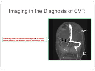 Imaging in the Diagnosis of CVT:
MR venogram confirmed thrombosis (black arrows) of
right transverse and sigmoid sinuses and jugular vein.
 