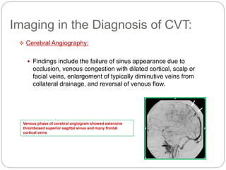 Imaging in the Diagnosis of CVT:
 Cerebral Angiography:
 Findings include the failure of sinus appearance due to
occlusion, venous congestion with dilated cortical, scalp or
facial veins, enlargement of typically diminutive veins from
collateral drainage, and reversal of venous flow.
Venous phase of cerebral angiogram showed extensive
thrombosed superior sagittal sinus and many frontal
cortical veins
 