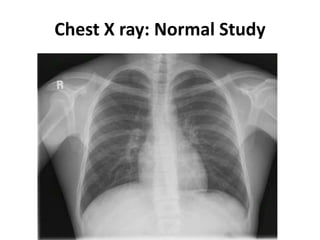 Chest X ray: Normal Study
 