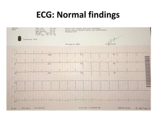 ECG: Normal findings
 