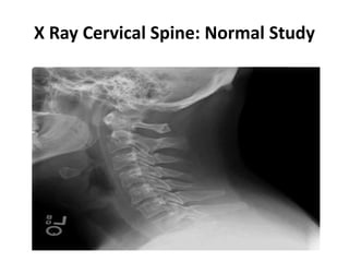 X Ray Cervical Spine: Normal Study
 