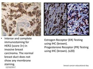 Case presentation of metastatic breast cancer | PPTX