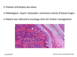 Case presentation of metastatic breast cancer | PPTX