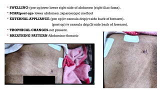  SWELLING-(pre op)over lower right side of abdomen (right iliac fossa).
 SCAR(post op)- lower abdomen ,laparoscopic method
 EXTERNAL APPLIANCE-(pre op)iv cannula drip(rt side back of forearm).
(post op) iv cannula drip(Lt side back of forearm).
 TROPHICAL CHANGES-not present.
 BREATHING PATTERN-Abdomino-thoracic
 