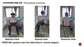  POSTURE-PRE OP -The posture is normal.
Anterior view Lateral view Posterior view
POST OP- posture can`t be taken due to recent surgery.
 