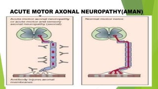 Case presentation on Guillain-Barré syndrom |neuromuscular disorder | PPTX