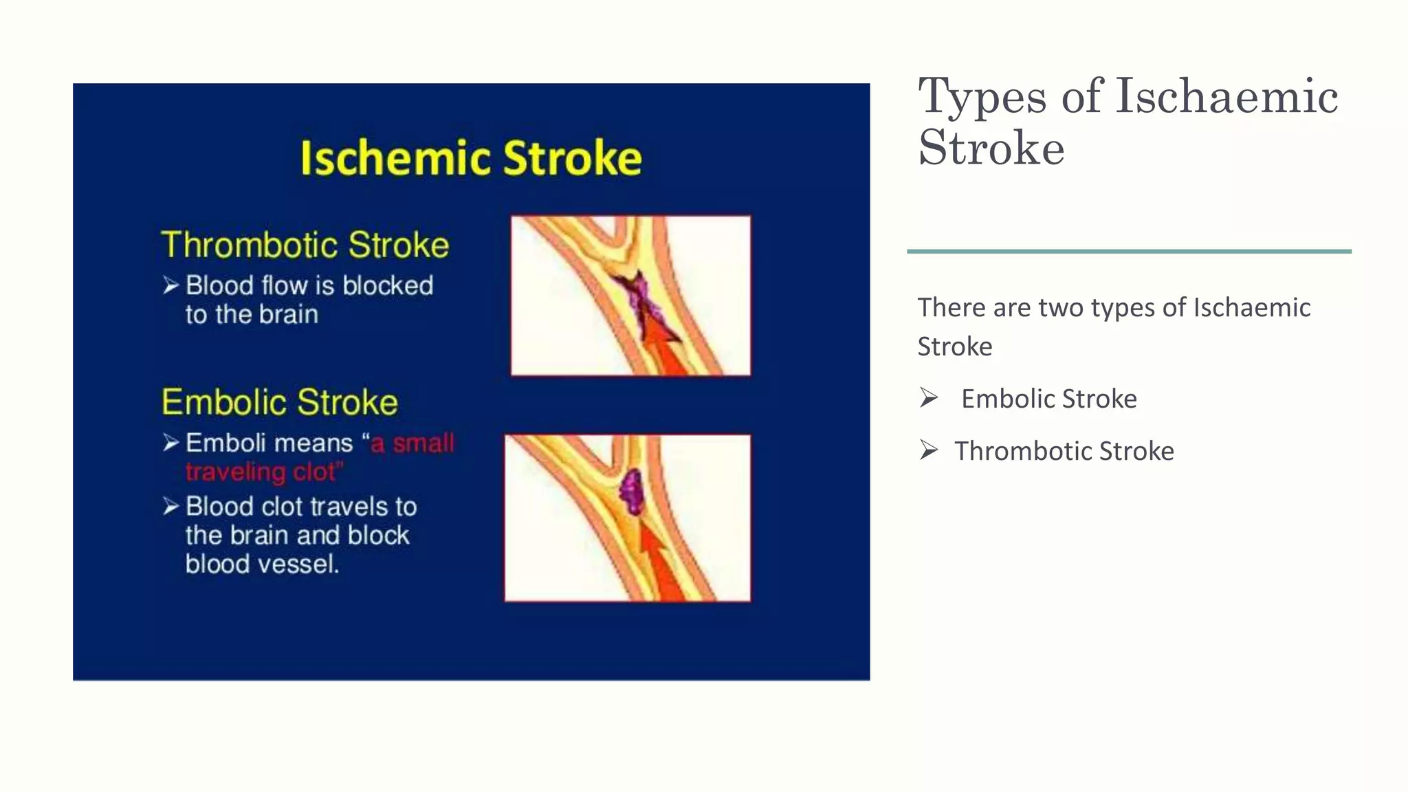 Types of Ischaemic
Stroke
There are two types of Ischaemic
Stroke
 Embolic Stroke
 Thrombotic Stroke
 
