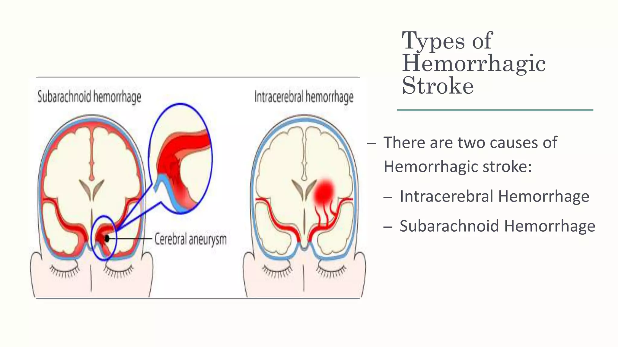 Types of
Hemorrhagic
Stroke
– There are two causes of
Hemorrhagic stroke:
– Intracerebral Hemorrhage
– Subarachnoid Hemorrhage
 