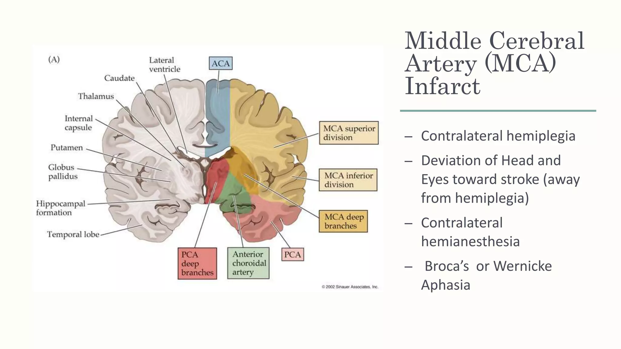 Middle Cerebral
Artery (MCA)
Infarct
– Contralateral hemiplegia
– Deviation of Head and
Eyes toward stroke (away
from hemiplegia)
– Contralateral
hemianesthesia
– Broca’s or Wernicke
Aphasia
 