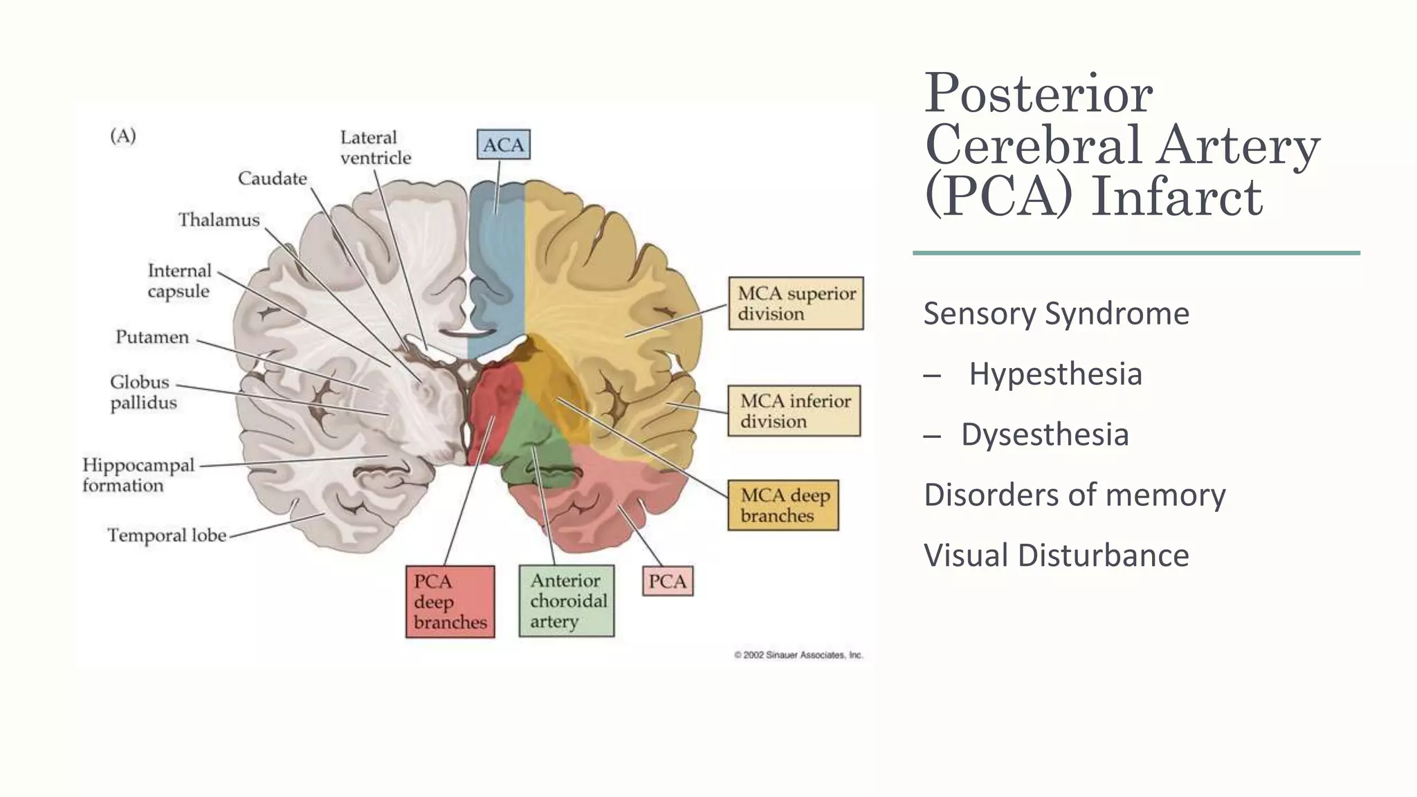 Posterior
Cerebral Artery
(PCA) Infarct
Sensory Syndrome
– Hypesthesia
– Dysesthesia
Disorders of memory
Visual Disturbance
 