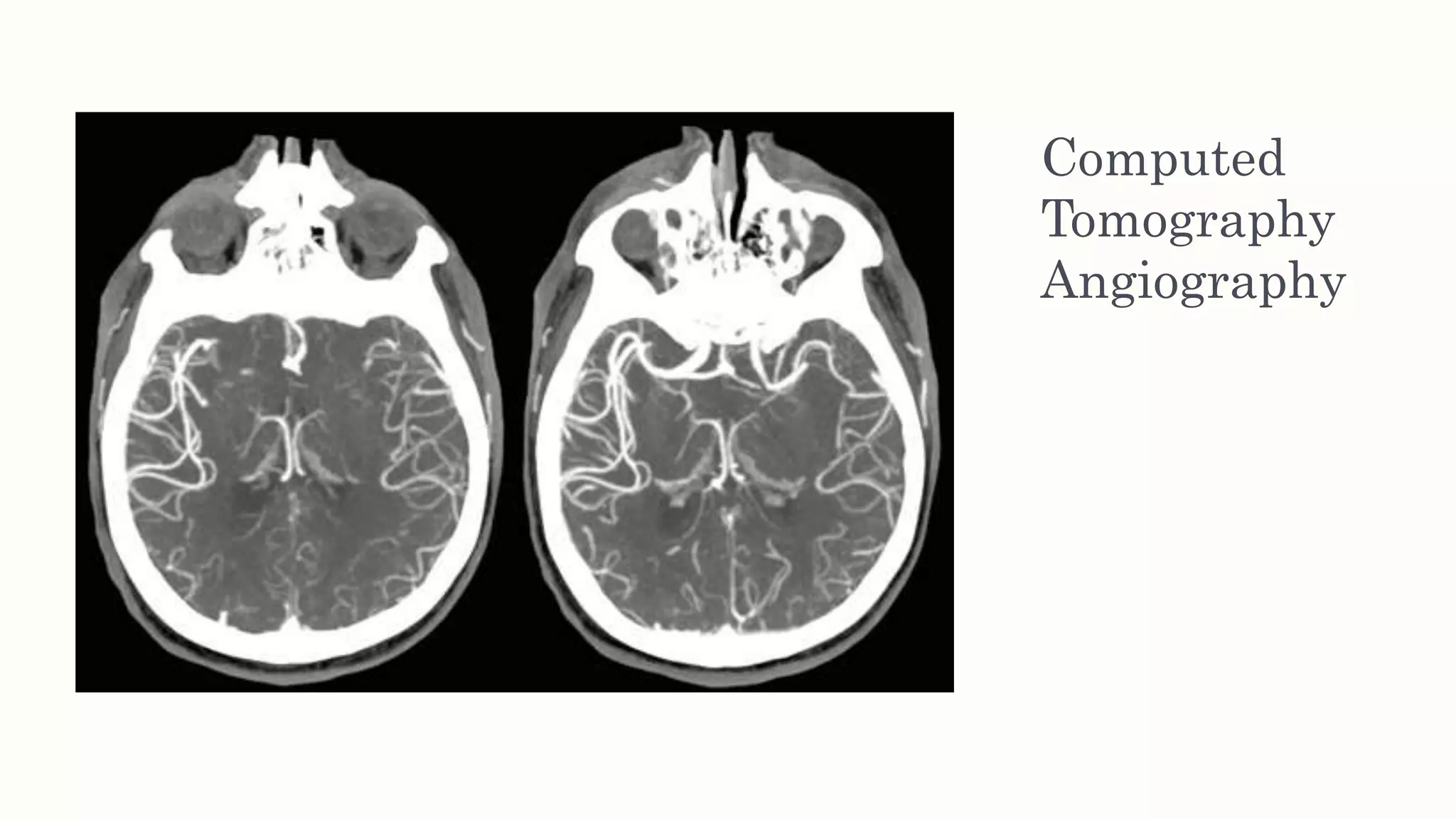 Computed
Tomography
Angiography
 