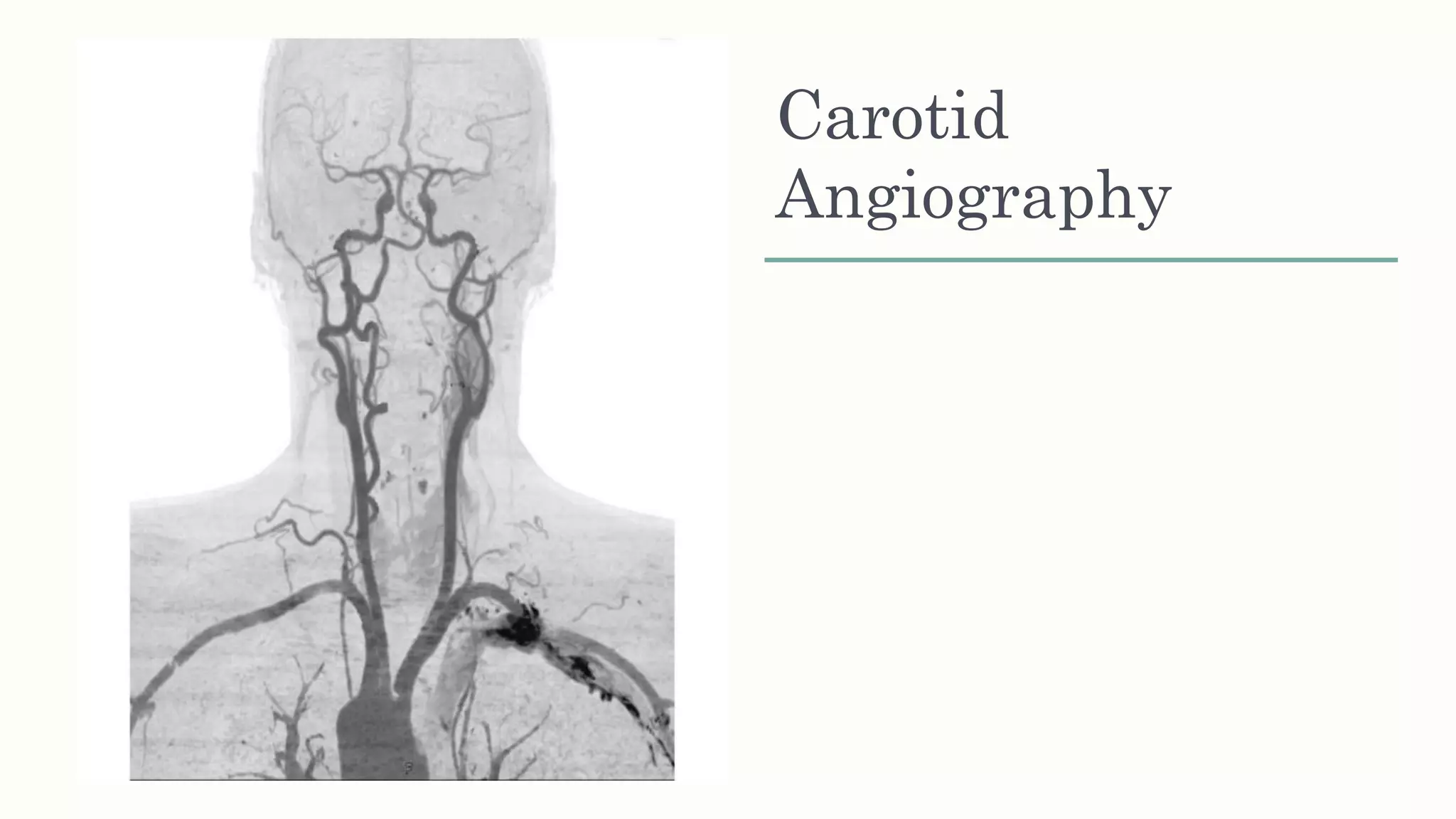Carotid
Angiography
 