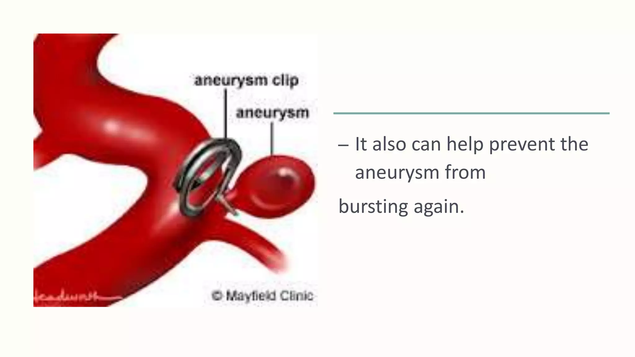– It also can help prevent the
aneurysm from
bursting again.
 